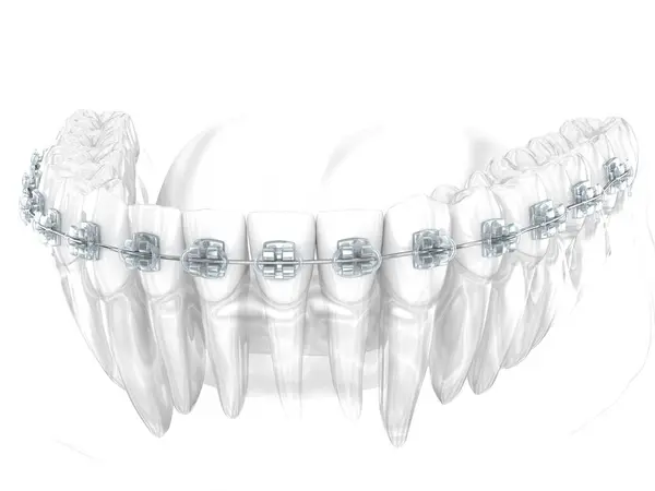 Aparelhos Dentários Dentes Ilustração Fotografia De Stock