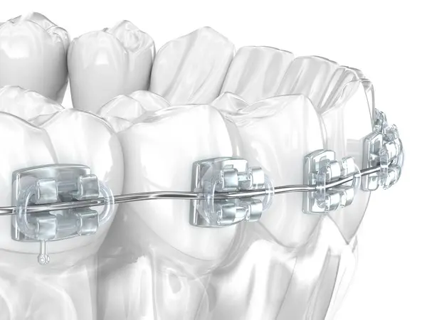 歯科用ブレースと歯 3Dイラスト ロイヤリティフリーのストック画像