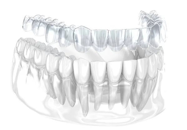 Diş Telleri Görünmez Diş Telleri Isırık Düzeltmesini Sağlar Illüstrasyon Telifsiz Stok Imajlar