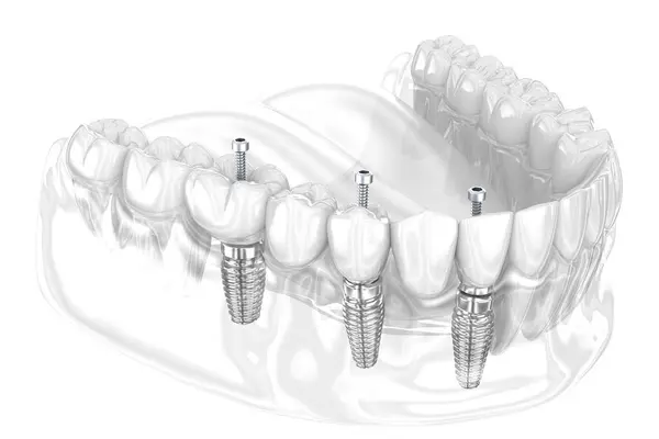 Zubní Můstek Založený Implantátech Zubní Ilustrace Royalty Free Stock Obrázky