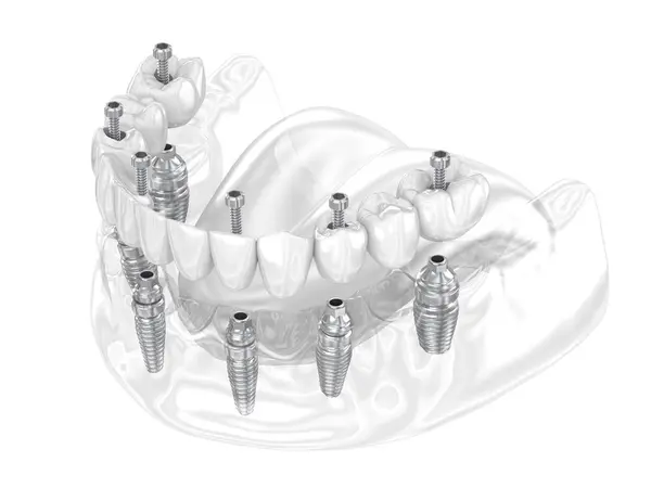 Tandprothese Ondersteund Door Zes Implantaten Tandheelkundige Illustratie Rechtenvrije Stockfoto's