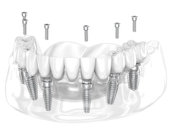 Zahnersatz Der Von Sechs Implantaten Unterstützt Wird Zahnärztliche Illustration Stockbild
