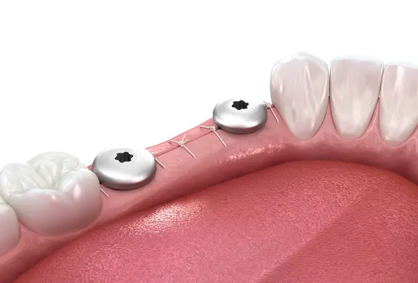 インプラントの上に元の歯茎 医学的に正確な3Dイラスト ストック写真