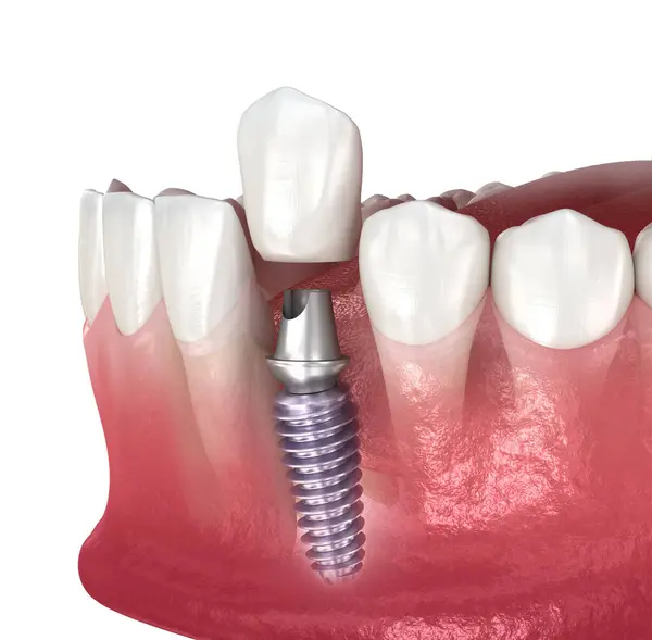 Tandheelkundig Implantaat Keramische Kroon Medisch Nauwkeurige Tand Illustratie Rechtenvrije Stockafbeeldingen