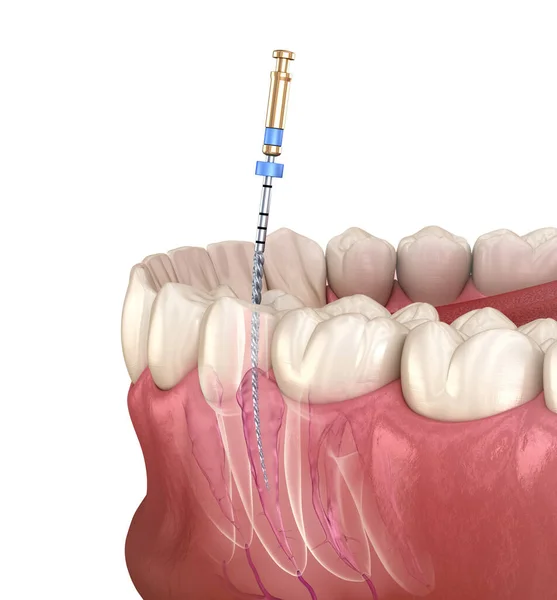 内因性根管治療プロセス 医学的に正確な歯3Dイラスト ストックフォト