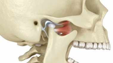 Temporomandibular eklemler ve çıkık eklem diski. Tıbbi olarak doğru 3B canlandırma