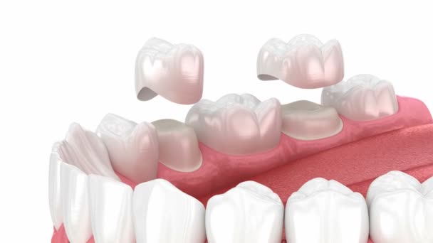 Tandkronor Placering Över Tänderna Animering För Tandläkare — Stockvideo