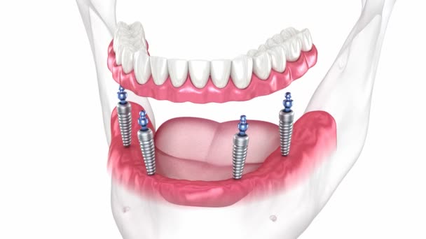 Proteser Som Stöds Implantat Animering För Tandläkare — Stockvideo