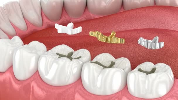 Rellenos Dentales Cerámica Dorado Metal Animación Dental — Vídeo de stock