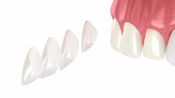 Procedimento Colocação Folheado Dentário Animação Dental — Vídeo de Stock