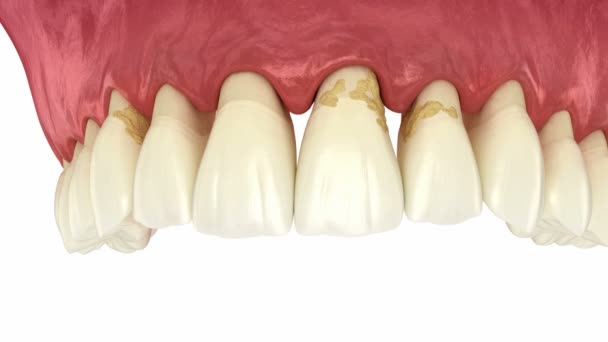 Periodontitis Gum Recession Dynamics Teeth Losing Dental Animation — Stok video