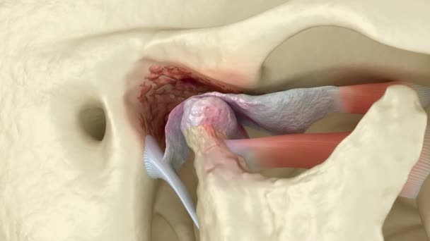 Arthrose Des Articulations Temporomandibulaires Dislocation Disque Articulaire Animation Dentaire — Video