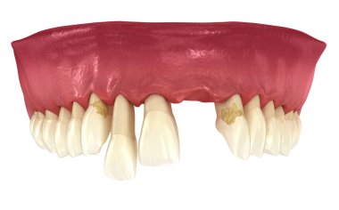 Periodontit ve sakız durgunluğu. Tıbbi olarak doğru 3B illüstrasyon