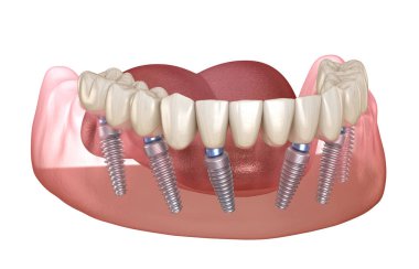 Çene protezi. Hepsi de implantlarla desteklenen 6 sistemde. İnsan dişleri ve protez kavramının tıbben doğru üç boyutlu çizimi