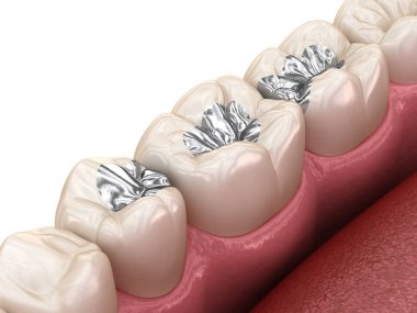 Amalgam restorasyonu. Diş konseptinin tıbben doğru 3 boyutlu animasyonu