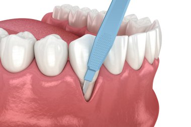 Gingiva durgunluğu, yumuşak doku nakli ameliyatı. Diş tedavisinin 3 boyutlu illüstrasyonu