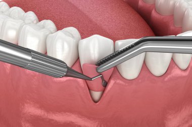 Gingiva durgunluğu, yumuşak doku nakli ameliyatı. Diş tedavisinin 3 boyutlu illüstrasyonu