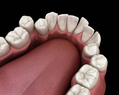 Aşırı kalabalık dişler, anormal diş tıkanıklığı. Tıbbi olarak doğru diş 3D illüstrasyon