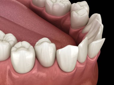 Aşırı kalabalık dişler, anormal diş tıkanıklığı. Tıbbi olarak doğru diş 3D illüstrasyon