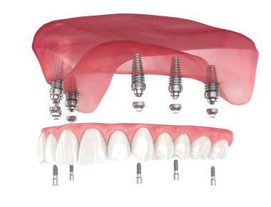 Çikletli Maxillary protezi. Hepsi de 6 implantla desteklenmiş. Diş 3B illüstrasyon