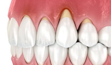 Gingiva durgunluğu. Diş sorununun 3 boyutlu illüstrasyonu