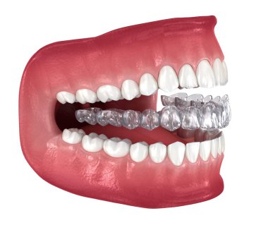 Invisalign braces or invisible retainer. Medically accurate dental 3D illustration clipart