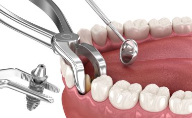 Diş çıkarma ve implantasyon, karmaşık acil ameliyat. Diş 3B illüstrasyon