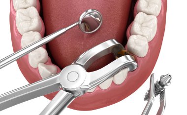 Diş çıkarma ve implantasyon, karmaşık acil ameliyat. Diş 3B illüstrasyon