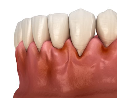 Diş etlerinde diş eti iltihabı. Diş 3B illüstrasyon