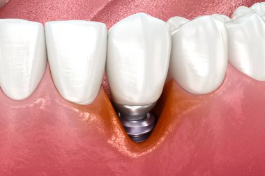 Peri-implantit ve gözle görülür gingiva durgunluğu. Tıbbi olarak doğru 3B illüstrasyon.
