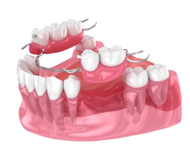 Çıkarılabilir kısmi takma diş, çene protezi. Medikal olarak protodontik konseptin 3 boyutlu çizimi