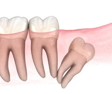 Yirmilik dişin etkisi. Tıbbi olarak doğru diş 3D illüstrasyon