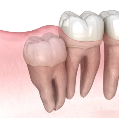 Yirmilik dişin etkisi. Tıbbi olarak doğru diş 3D illüstrasyon