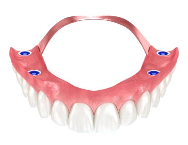 Altı implanta dayalı çıkarılabilir protez. Diş 3B illüstrasyon