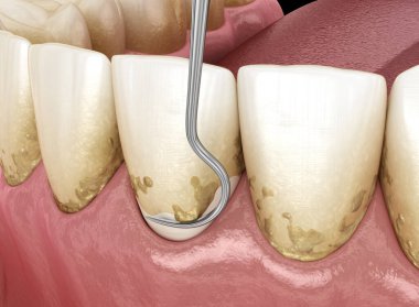 Ağız temizliği: Ölçekleme ve kök planlama (geleneksel periodontal terapi). İnsan diş tedavisinin tıbbi açıdan doğru üç boyutlu çizimi