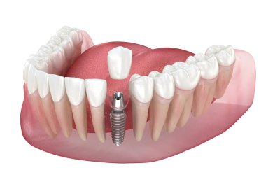 Diş implantı ve seramik taç. Tıbbi olarak doğru diş 3D illüstrasyon.