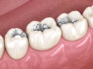Amalgam restorasyonu. Diş konseptinin tıbben doğru 3 boyutlu animasyonu