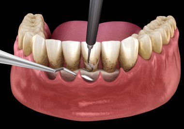 Açık curettage: Ölçekleme ve kök planlama (geleneksel periodontal terapi). 3B illüstrasyon
