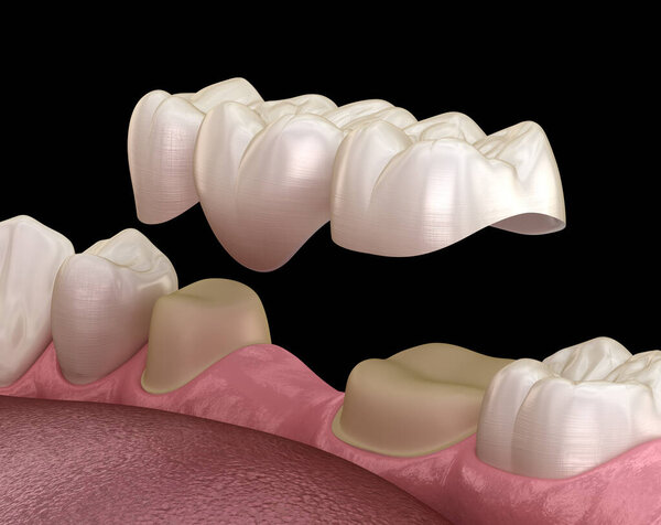 Dental bridge of 3 teeth over molar and premolar. Medically accurate 3D illustration of human teeth treatment