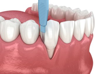 Gingiva durgunluğu, yumuşak doku nakli ameliyatı. Diş tedavisinin 3 boyutlu illüstrasyonu