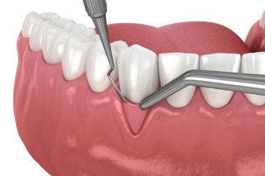 Gingiva durgunluğu, yumuşak doku nakli ameliyatı. Diş tedavisinin 3 boyutlu illüstrasyonu