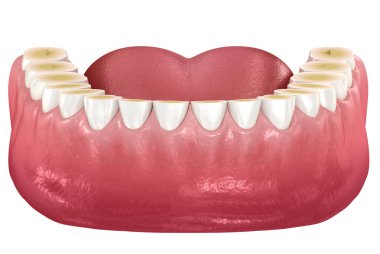 Diş çürümesi (Bruxism) diş dokusunun kaybıyla sonuçlanır. Diş 3B illüstrasyon