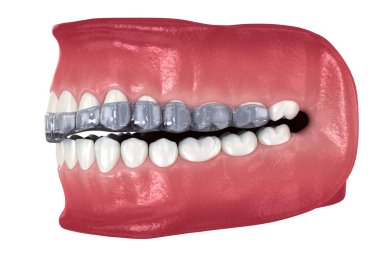 Diş telleri ya da görünmez diş telleri. Tıbbi olarak doğru olan 3 boyutlu diş illüstrasyonu