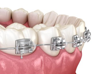Metal diş telleri. Tıbbi olarak doğru 3B illüstrasyon