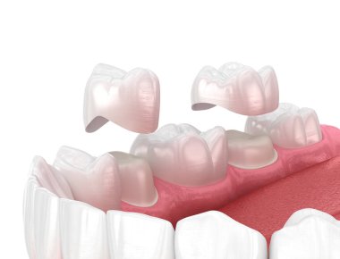 Porcelain crowns placement over premolar and molar teeth. Medically accurate 3D illustration