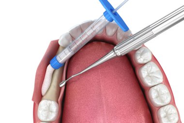 Diş nakli için kemik nakli nakli. Tıbbi olarak doğru 3B illüstrasyon.