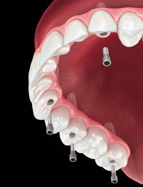 6 implanta dayalı Maxillary protezi. Diş 3B illüstrasyon