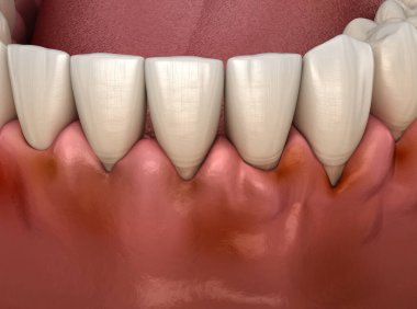 Diş etlerinde diş eti iltihabı. Diş 3B illüstrasyon