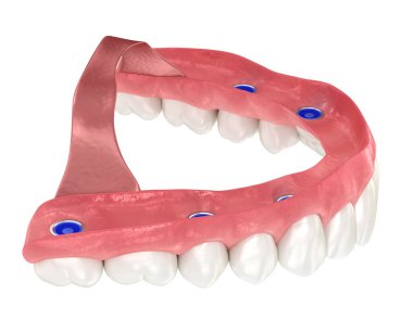 Çikletli Maxillary protezi. Hepsi 6 sistemde. Diş 3B illüstrasyon