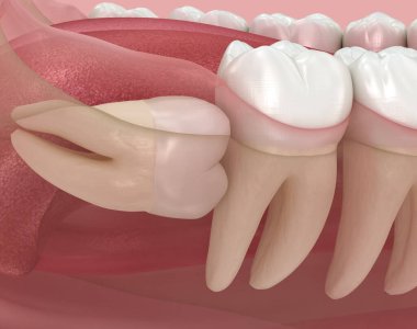 Bilgelik dişinin yatay etkisi. Tıbbi olarak doğru diş 3D illüstrasyon
